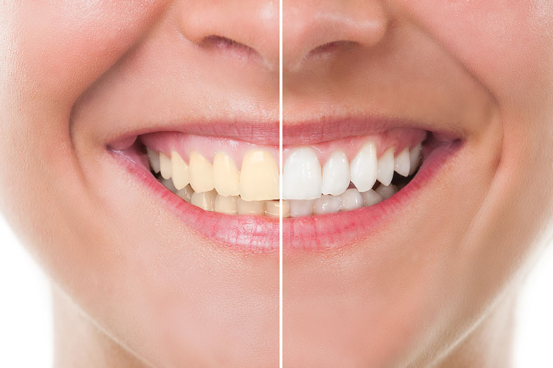 Teeth Whitening - Dental Center of Naperville, Naperville Dentist